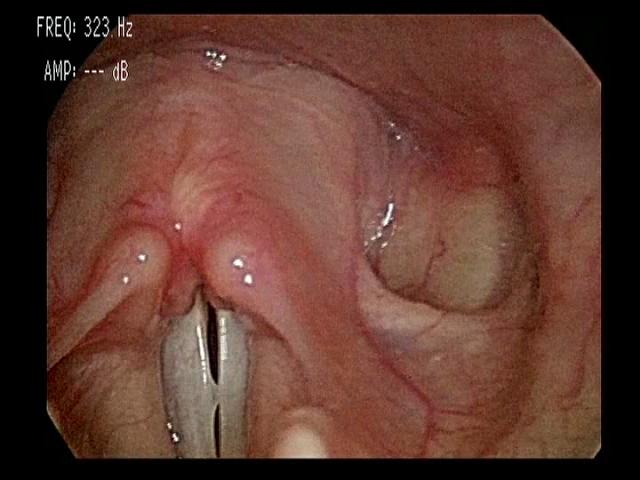 Pre-surgical image of a polyp on a patient’s vocal cord.